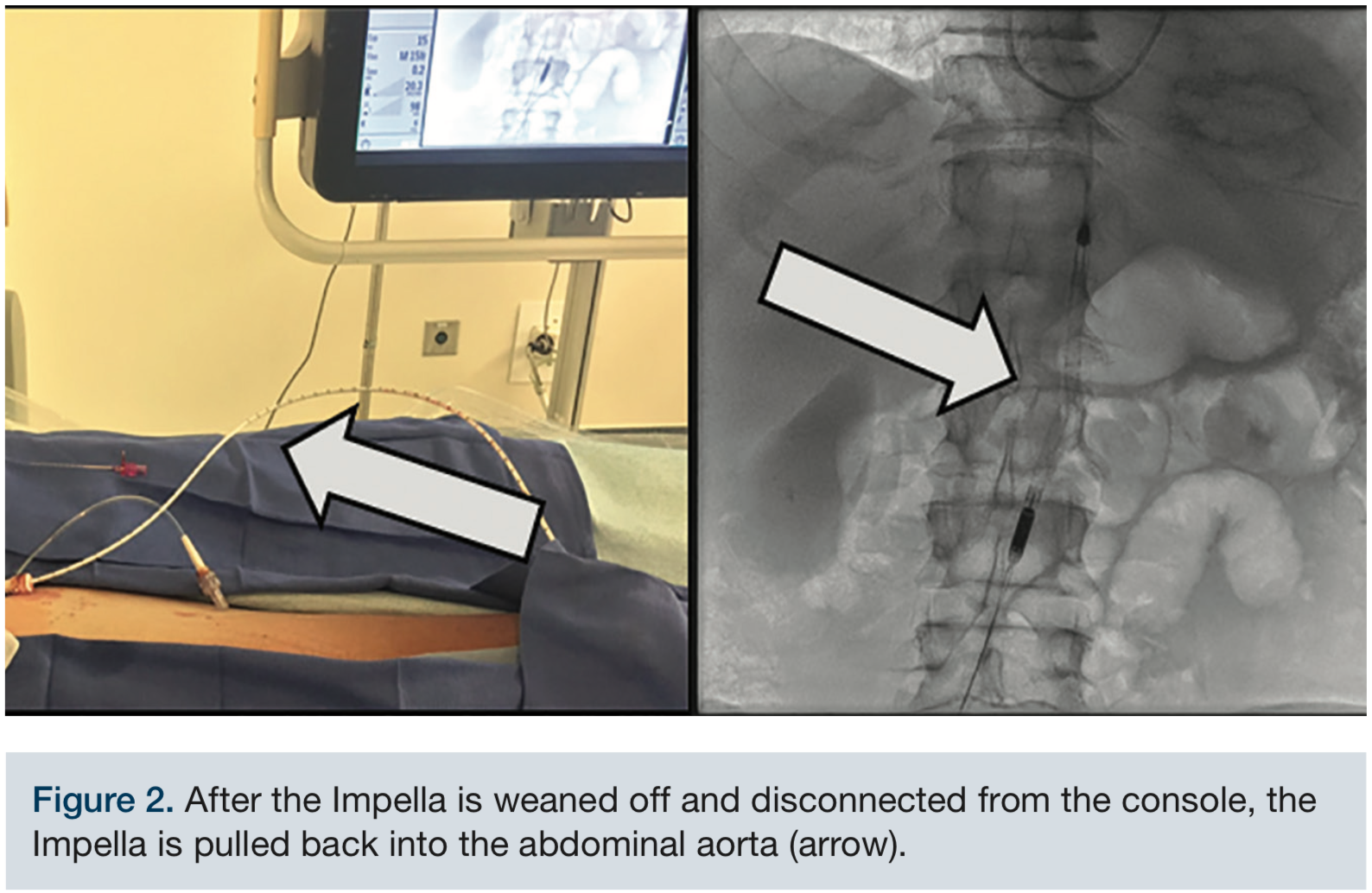 A Novel Technique for Impella Removal From NonPreclosed Arteries Using